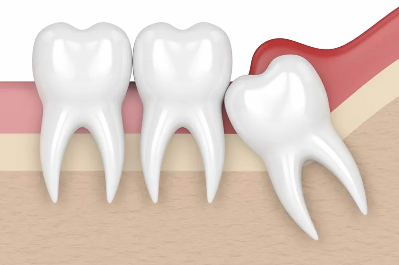 Wisdom Tooth Removal
