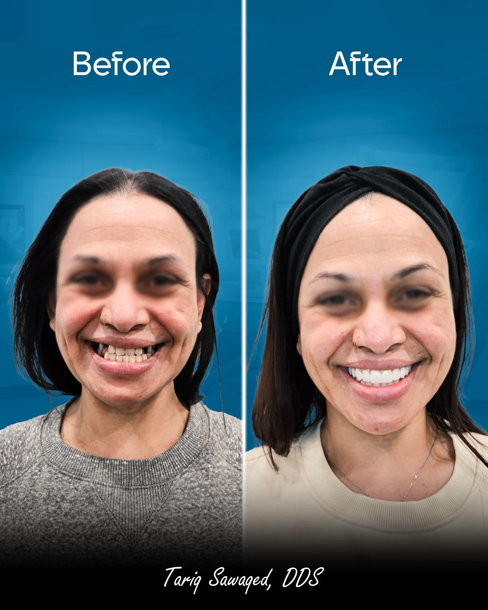 Before and after smile transformation of a woman
