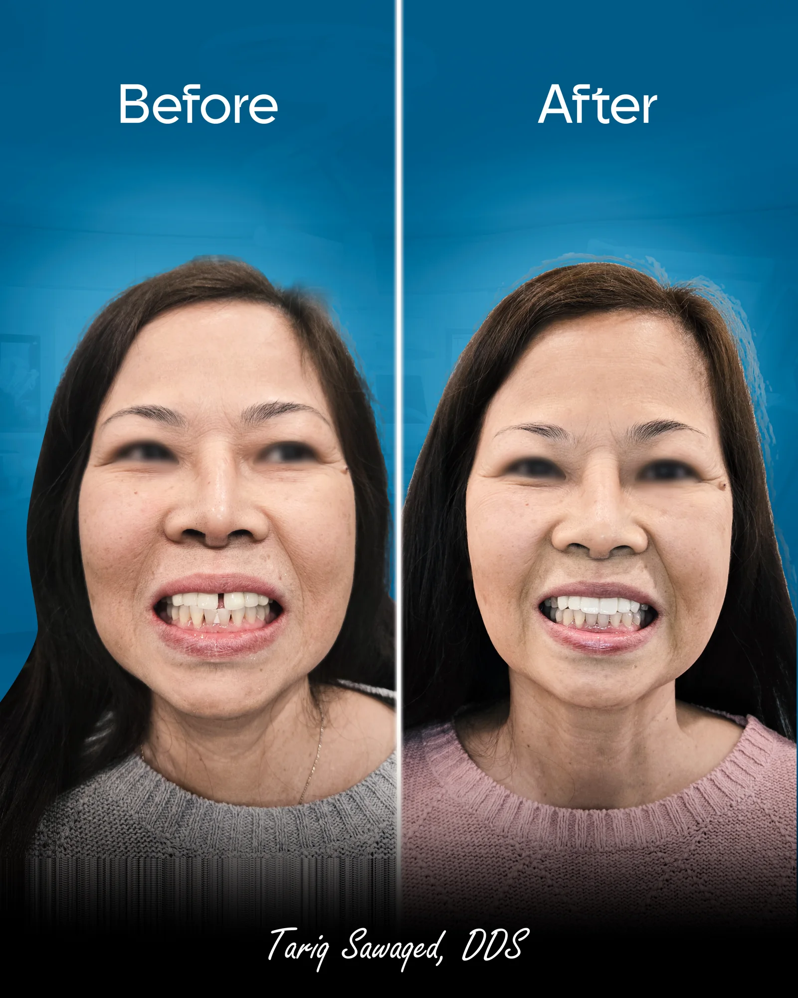 Before and after smile transformation of a woman