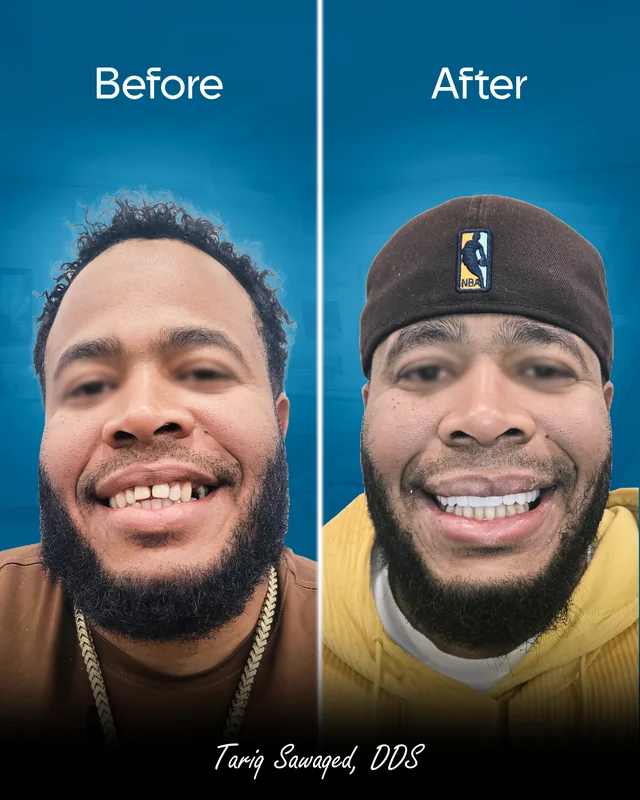 Before and after dental implant smile transformation